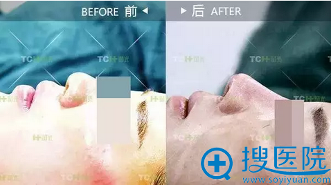 术后即刻效果对比原本塌陷的鼻子瞬间变挺拔 术后即刻效果对比原本塌陷的鼻子瞬间变挺拔