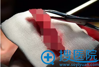 吕院长从小张鼻部取出的“骨粉” 吕院长从小张鼻部取出的“骨粉”