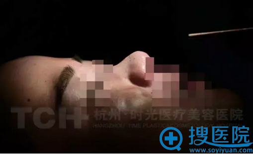 完成取骨粉步骤骨粉取出后,小张鼻子立刻坍塌成“鞍鼻” 完成取骨粉步骤骨粉取出后,小张鼻子立刻坍塌成“鞍鼻”