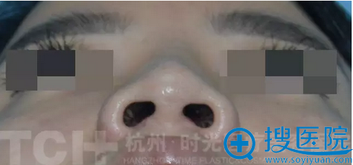术前小张鼻小柱鼻头坍塌无型 术前小张鼻小柱鼻头坍塌无型