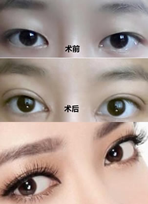 记录我刚在上海华安整形花999元割双眼皮的恢复过程 效果太好了