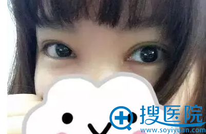 双眼皮第七天,还有点肿 双眼皮第七天,还有点肿