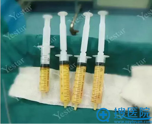 无菌环境下提纯的优质、高活性脂肪 无菌环境下提纯的优质、高活性脂肪