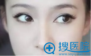 我较爱的双眼皮效果 我较爱的双眼皮效果