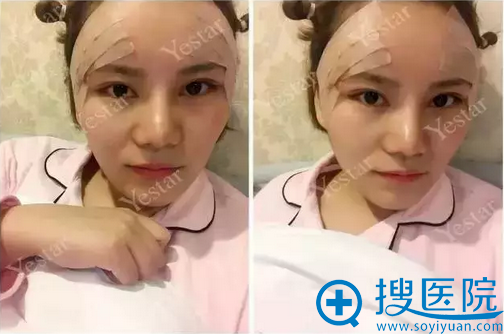 自体脂肪填充丰太阳穴术后天效果 自体脂肪填充丰太阳穴术后天效果