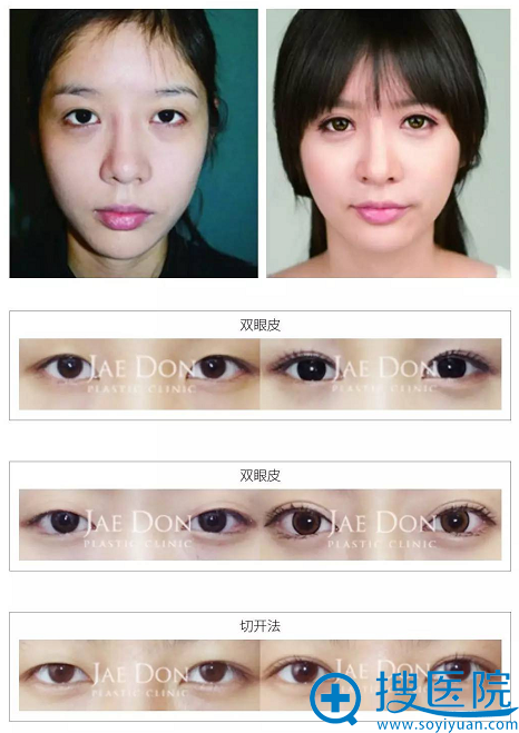 大连奥克拉李孝连院长双眼皮手术前后对比案例 大连奥克拉李孝连院长双眼皮手术前后对比案例