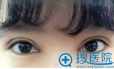 双眼皮12天的效果,坐等恢复 双眼皮12天的效果,坐等恢复