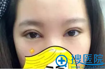 双啊眼皮第四天,要多冰敷 双啊眼皮第四天,要多冰敷