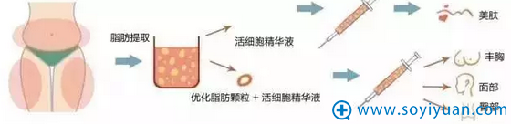 自体脂肪填充示意图 自体脂肪填充示意图