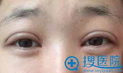 双眼皮失败案例 双眼皮失败案例