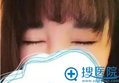 双眼皮30天效果,闭眼无痕 双眼皮30天效果,闭眼无痕