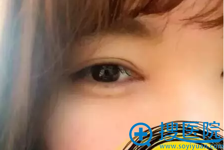 双眼皮20天了 双眼皮20天了