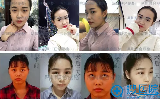 <!--<i data=20240710 data-id=12014></i>-->整形医院双眼皮案例 <!--<i data=20240710 data-id=12014></i>-->整形医院双眼皮案例