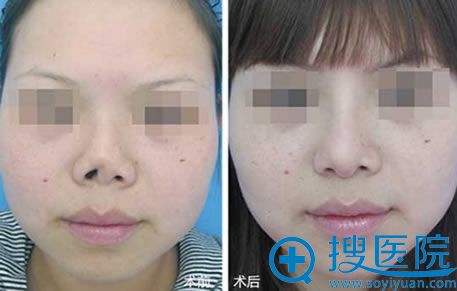 <!--<i data=20240710 data-id=16682></i>-->教授隆鼻案例对比图 <!--<i data=20240710 data-id=16682></i>-->教授隆鼻案例对比图