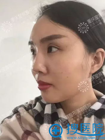 自体脂肪填充术后七天侧面照 自体脂肪填充术后七天侧面照