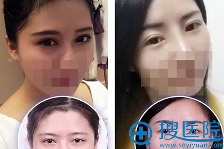 <!--<i data=20240710 data-id=8229></i>-->双眼皮案例对比图 <!--<i data=20240710 data-id=8229></i>-->双眼皮案例对比图