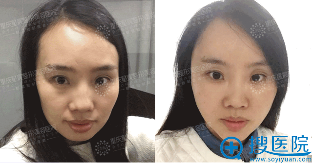 【经历】重庆星宸整形医院自体脂肪填充面部太阳穴7天堪比磨骨