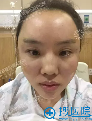 自体脂肪填充术后一天照 自体脂肪填充术后一天照