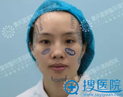 全面部自体脂肪填充方案设计完成 全面部自体脂肪填充方案设计完成