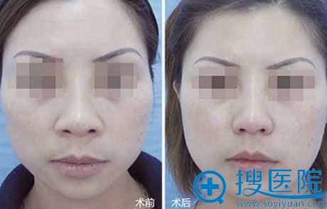 <!--<i data=20240710 data-id=16682></i>-->教授隆鼻案例对比图 <!--<i data=20240710 data-id=16682></i>-->教授隆鼻案例对比图
