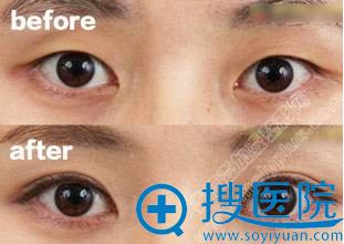 合肥壹加壹甘泉涌双眼皮对比 合肥壹加壹甘泉涌双眼皮对比