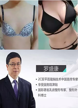 【隆胸日记】在新疆华美找罗盛康教授隆胸术后一个月恢复过程