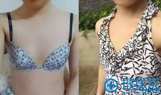 在新疆华美找罗盛康教授隆胸前的照片 在新疆华美找罗盛康教授隆胸前的照片
