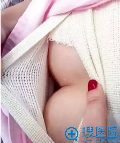 在新疆华美隆胸术后第3天 在新疆华美隆胸术后第3天
