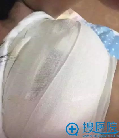 找罗盛康教授隆胸术后第1天 找罗盛康教授隆胸术后第1天