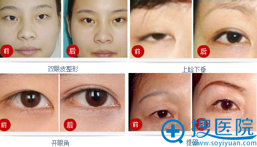 厦门海峡整形美容医院眼整形案例展示 厦门海峡整形美容医院眼整形案例展示