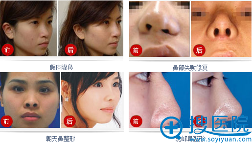 厦门海峡整形美容医院鼻整形案例展示 厦门海峡整形美容医院鼻整形案例展示