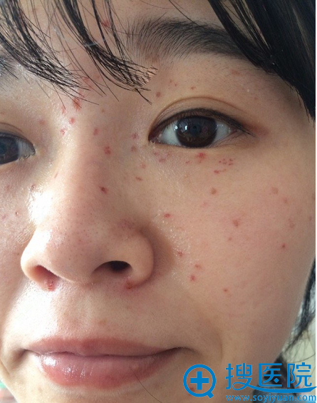【经历】看我花8800元在西宁华美整形医院做激光祛斑效果怎么样