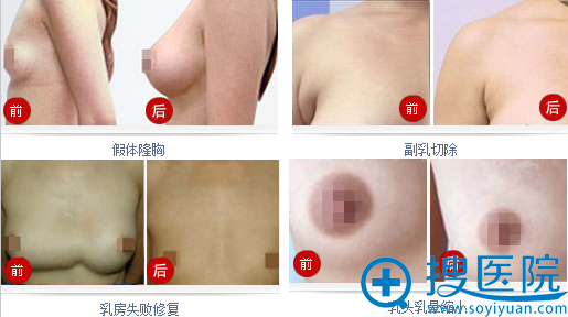 厦门海峡整形美容医院胸整形案例展示 厦门海峡整形美容医院胸整形案例展示