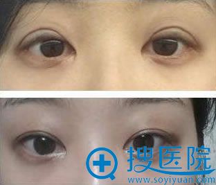 杜园园修复双皮案例对比 杜园园修复双皮案例对比