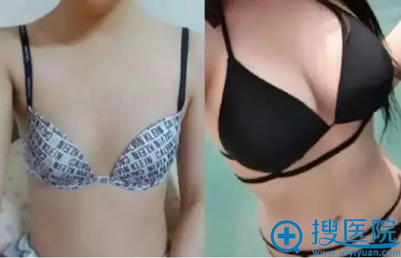 找罗盛康教授隆胸前后对比图 找罗盛康教授隆胸前后对比图