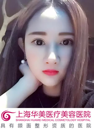 【整形日记】在上海华美找李志海做颧弓内推和下颌角恢复效果