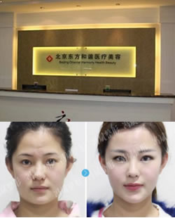 北京东方和谐正规吗? 冯斌自体脂肪丰苹果肌特价9900元+案例