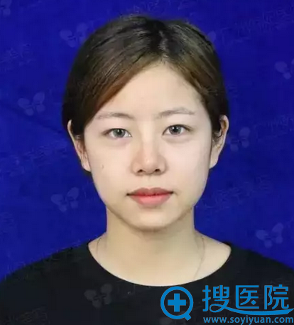 【真人案例】东莞唯美医疗美容医院双眼皮+自体脂肪填充面部