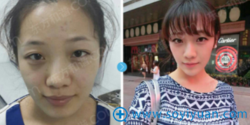 <!--<i data=20240710 data-id=12086></i>-->和谐冯斌自体脂肪填充案例 <!--<i data=20240710 data-id=12086></i>-->和谐冯斌自体脂肪填充案例