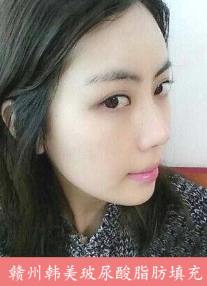 在赣州韩美整形美容医院做了玻尿酸脂肪填充手术花了18000元