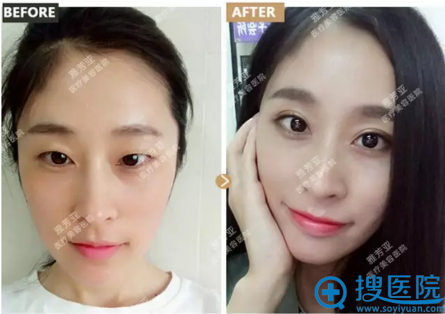 【经历】在石家庄雅芳亚找丁庆丰院长做无痕翘睫双眼皮的恢复图