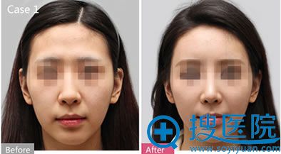 上海华美面部脂肪填充前后对比图 上海华美面部脂肪填充前后对比图
