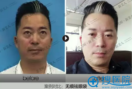 长沙芯美昕整形美容医院禾<!--<i data=20240710 data-id=17462></i>-->院长无痕去眼袋案例一 长沙芯美昕整形美容医院禾<!--<i data=20240710 data-id=17462></i>-->院长无痕去眼袋案例一