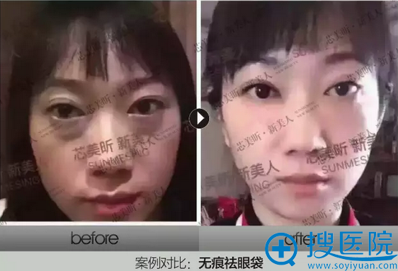 长沙芯美昕整形美容医院禾<!--<i data=20240710 data-id=17462></i>-->院长无痕去眼袋案例三 长沙芯美昕整形美容医院禾<!--<i data=20240710 data-id=17462></i>-->院长无痕去眼袋案例三
