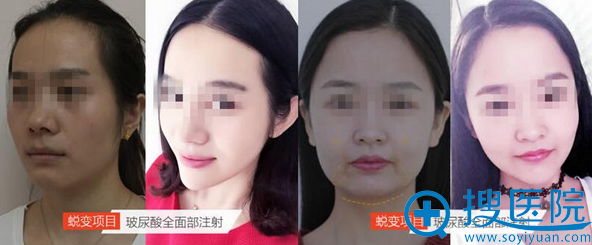 注射微整特惠专场 注射微整特惠专场
