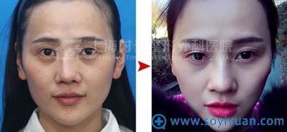 上海时光鼻整形修复案例对比图 上海时光鼻整形修复案例对比图