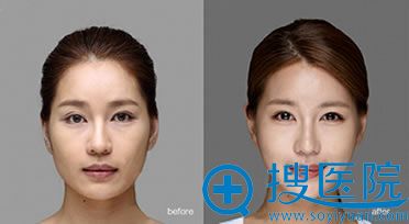 上海华美颧骨缩小术前后对比图 上海华美颧骨缩小术前后对比图