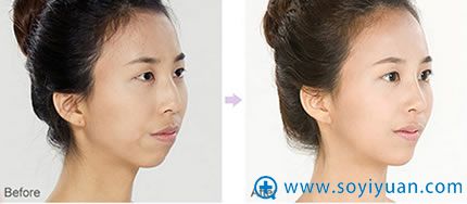 上海华美鹰沟鼻整形案例对比 上海华美鹰沟鼻整形案例对比
