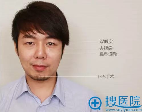 手术苏项目:双眼皮+祛眼袋+垫下巴 手术苏项目:双眼皮+祛眼袋+垫下巴