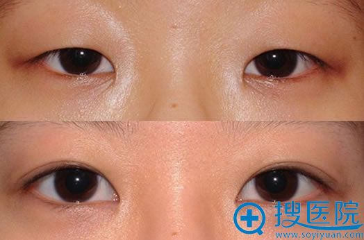 贵阳美莱整形医院双眼皮对比案例 贵阳美莱整形医院双眼皮对比案例